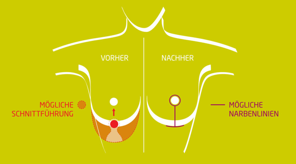 Bruststraffung-Innerer-BH-Technik-Schnitt